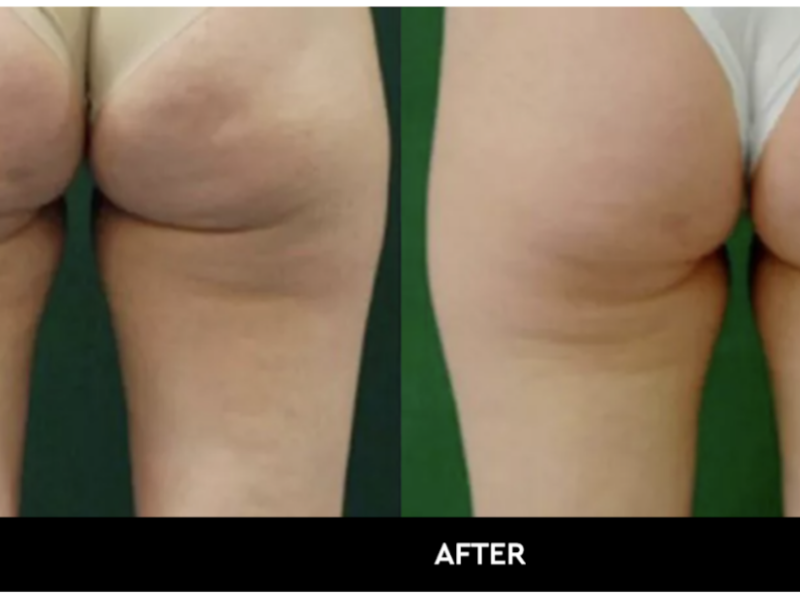 Cellulite removal treatment Aesthetics labs